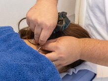 ミヤビ(MIYABI)/ボディ鍼/肩こり/首痛/腰痛