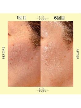 ニコホリ(NIKOHORI)/エクソリフト/フェイシャル/美肌