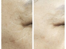 クリアー(CLEAR.)/【Before＆After】