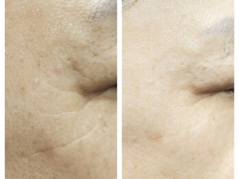 クリアー(CLEAR.)/【Before＆After】