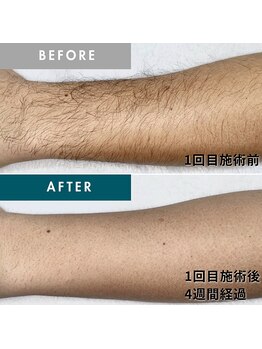 モモナ(Momona)/佐世保/脱毛/腕脱毛/うで脱毛