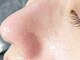 ティーティービューティー(TT Beauty)の写真/《毛穴エクストラクション》黒ずみ毛穴や潜んでる角質や産毛などをきれいにざらつきのないつる艶肌に!