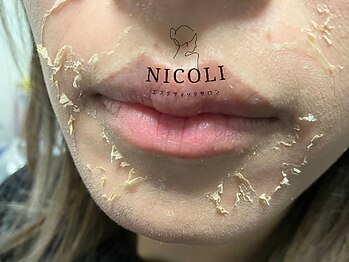 ニコリ(NICOLI)/ハーブピーリング後　Lv1、4、7