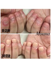 モアナ 池袋(MOANA)/人工爪深爪