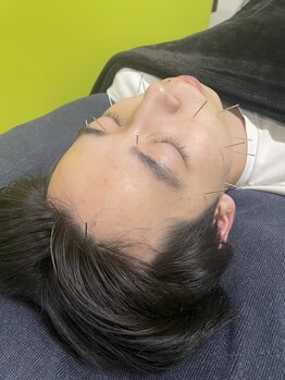 甲斐整骨院 新屋敷院/美容鍼