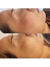 ヴィアス(Vias)/プラズマスペシャルコース