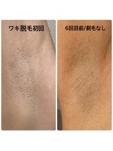 ソアン(Soin)/ワキ脱毛