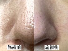 エミナル(eminal)/ビフォー/アフター/毛穴/梅田