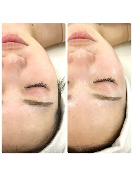 ベル(Belle)の写真/艶玉肌セルマン◆艶玉爆誕!セルマン幹細胞フェイシャル♪角質を整え磨けば磨くほど艶めく素肌♪ニキビケア