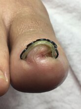 巻き爪矯正センター 沖縄 宜野湾/巻きが強い方のビフォーアフー