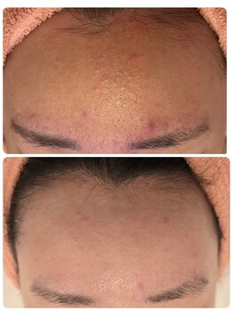 サロンド シェリー(Salon de Cherie)/ハーブピーリング