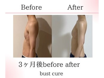 サロンツキ(salon tuki)/バストケア症例/徳島