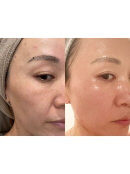 ホウレイ線・たるみ改善！予防ケア