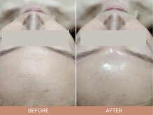 脱毛サロン ベル(Bell)の雰囲気（韓国美容♪肌育ピーリングをぜひご体験ください！）