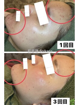 ソルカナ(Solkana)の写真/【剥離なし！ ハーブピーリング &nbsp;大注目ブランドクリスティーナ使用】◆痛みの少ない施術で徹底肌改善へ◎