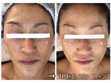アルページュ(Arpege)の雰囲気（肌ムラ/シミに◎韓国光肌管理で夏のシミ肌ムラ分解し秋に備える）