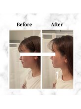 ザビューティー 麻布十番本店(The Beauty)/12Dリフト全顔打ち放題[リフト]