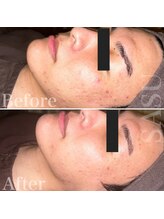 サス(SASU)/肌荒れや肌質改善に