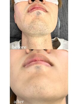 シャイン 佐賀店(SHINE)/髭脱毛ビフォーアフター