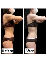 クールヴィラ(Cool Villa)/二の腕ビフォーアフター