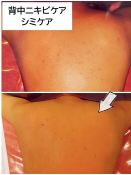 ビューティースパ/【7回】背中ニキビケア&シミケア