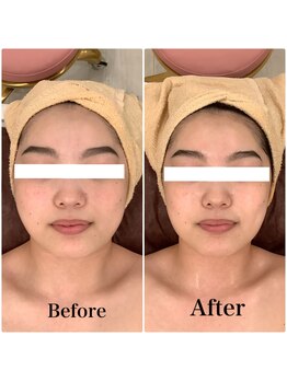 スペチアーレ 夙川/小顔ハイリフ無制限全顔