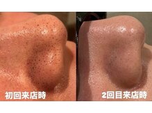 モアトゥインクル 福山宮通り店(MORE twinkle)の雰囲気（毛穴のお悩みもお任せください♪）