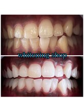 ホワイトニングショップ 大阪玉造店/Before&After美白ホワイトニング