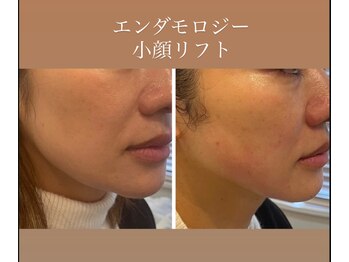 アールグランド 学芸大学店(R-ground)/エンダモロジーフェイスリフト