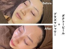 ギルドハナレ(GUILD HANARE)/"毛穴×くすみ"