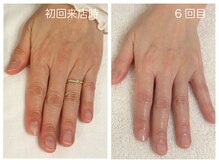 キレイテ 福岡天神店/50代/6回目【大名ハンドケア】