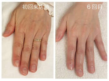 キレイテ 福岡天神店/50代/6回目【大名ハンドケア】