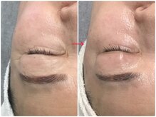 オージャス(OJAS)/50代/1回で！目元小じわ改善