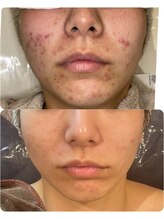 ハクビューティー(HAKU BEAUTY)/20代ニキビ/肌質改善はできる