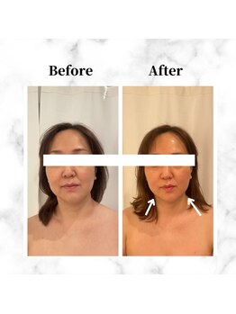 ザビューティー 麻布十番本店(The Beauty)/12Dリフト全顔打ち放題[リフト]