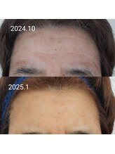 エヌミー(N me)/ADSシミ改善