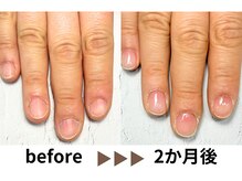 ナチュリア(Natulea)/深爪自爪育成2か月の変化