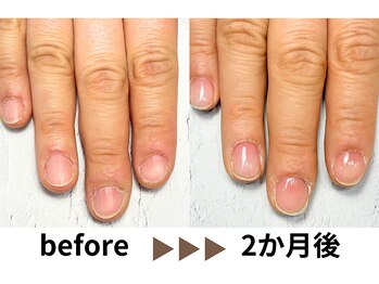 深爪自爪育成2か月の変化