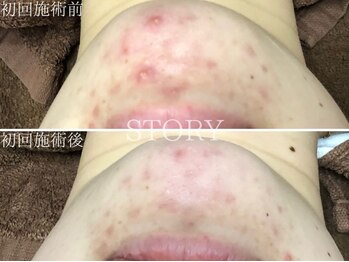 ストーリー 沼津店(STORY)/ハーブピーリング専門店STORY