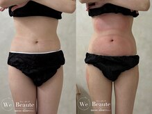 ウィボーテ(We Beaute)/【痩身】脂肪冷却×脂肪分解