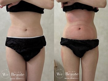 ウィボーテ(We Beaute)/【痩身】脂肪冷却×脂肪分解