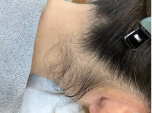 ブルーココア(BlueCocoa)/うなじ脱毛のビフォー写真です