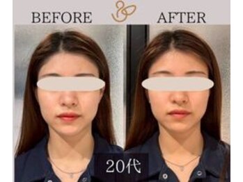 チョコバリ 新宿店(chocobari)/小顔×リフトアップ(美容鍼)20代