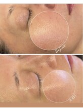 アリィ(Alii)/たるみ毛穴に効果大！