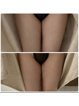 ソルニス(Solnis.)/痩身☆脂肪分解/ハイパーナイフ