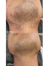 シャイン 佐賀店(SHINE)/髭脱毛ビフォーアフター