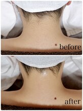 グロウ 脱毛サロン(GLOW)/えりあし&うなじ脱毛