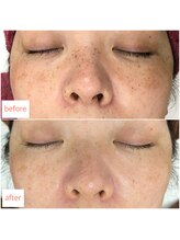 シュウ(Shuu)/シミケアのビフォーアフター