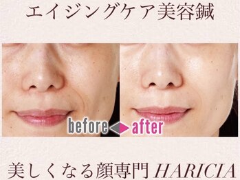ハリシア(HARICIA)/劇的ビフォーアフター