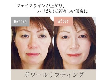 オワゾーブルー(Oiseaubleu)/ボワールリフティング・50代